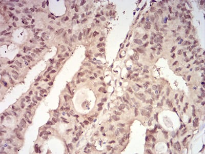 Figure 9:Immunohistochemical analysis of paraffin-embedded rectum cancer tissues using YWHAB mouse mAb with DAB staining.