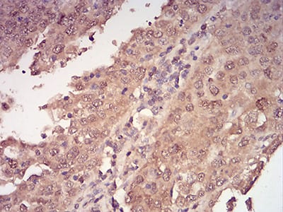 Figure 10:Immunohistochemical analysis of paraffin-embedded endometrial cancer tissues using YWHAB mouse mAb with DAB staining.