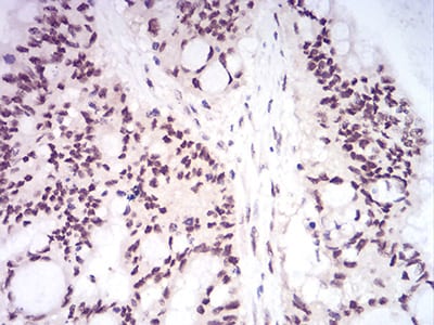 Figure 4:Immunohistochemical analysis of paraffin-embedded colon cancer tissues using DNMT1 mouse mAb with DAB staining.