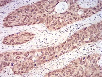 Figure 9:Immunohistochemical analysis of paraffin-embedded cervical cancer tissues using RAN mouse mAb with DAB staining.