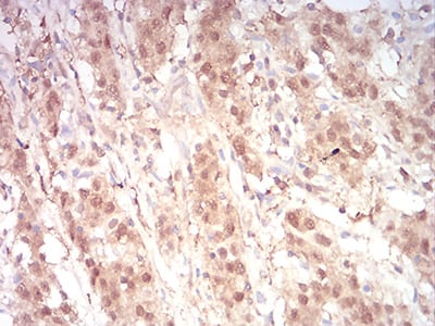 Figure 10:Immunohistochemical analysis of paraffin-embedded stomach cancer tissues using RAN mouse mAb with DAB staining.