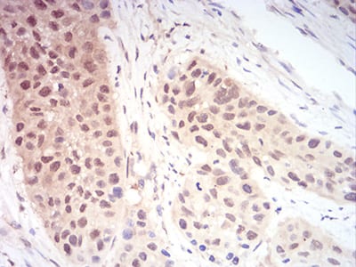 Figure 6:Immunohistochemical analysis of paraffin-embedded esophageal cancer tissues using RAN mouse mAb with DAB staining.