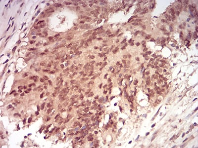 Figure 7:Immunohistochemical analysis of paraffin-embedded rectum cancer tissues using RAN mouse mAb with DAB staining.
