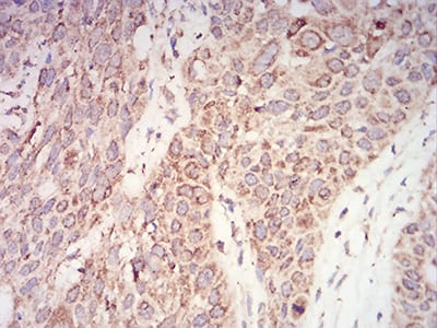 Figure 6:Immunohistochemical analysis of paraffin-embedded esophageal cancer tissues using AKT1 mouse mAb with DAB staining.