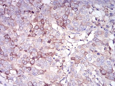 Figure 7:Immunohistochemical analysis of paraffin-embedded bladder cancer tissues using CDH11 mouse mAb with DAB staining.