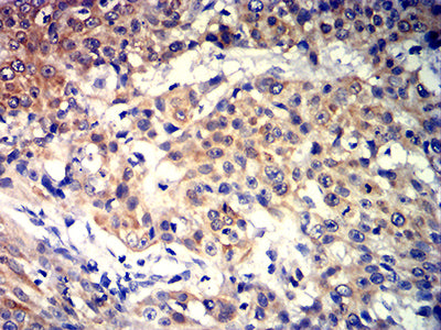 Figure 8:Immunohistochemical analysis of paraffin-embedded esophageal cancer tissues using KRT10 mouse mAb with DAB staining.