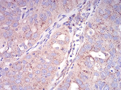 Figure 4:Immunohistochemical analysis of paraffin-embedded ovarian cancer tissues using SEC31A mouse mAb with DAB staining.