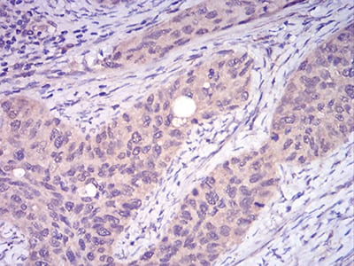Figure 8:Immunohistochemical analysis of paraffin-embedded cervical cancer tissues using TRAF2 mouse mAb with DAB staining.
