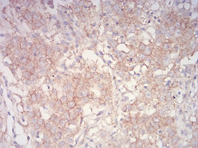 Figure 7:Immunohistochemical analysis of paraffin-embedded stomach cancer tissues using PYCARD mouse mAb with DAB staining.