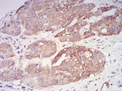 Figure 7:Immunohistochemical analysis of paraffin-embedded ovarian cancer tissues using PYCARD mouse mAb with DAB staining.