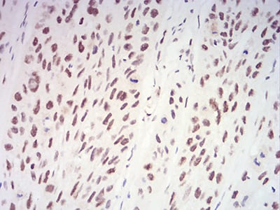 Figure 5:Immunohistochemical analysis of paraffin-embedded esophageal cancer tissues using XRN2 mouse mAb with DAB staining.