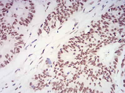 Figure 6:Immunohistochemical analysis of paraffin-embedded rectum cancer tissues using XRN2 mouse mAb with DAB staining.