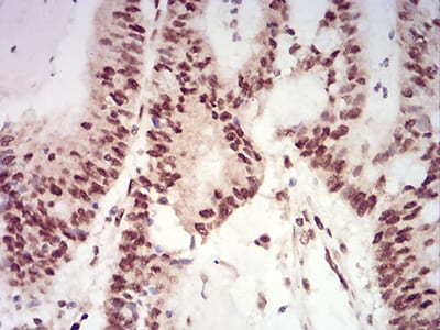 Figure 5:Immunohistochemical analysis of paraffin-embedded colon cancer tissues using XRN2 mouse mAb with DAB staining.