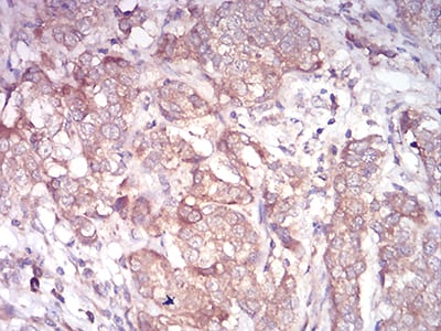 Figure 7:Immunohistochemical analysis of paraffin-embedded bladder cancer tissues using ARF1 mouse mAb with DAB staining.