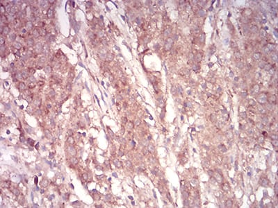 Figure 8:Immunohistochemical analysis of paraffin-embedded stomach cancer tissues using ARF1 mouse mAb with DAB staining.
