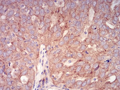 Figure 9:Immunohistochemical analysis of paraffin-embedded ovarian cancer tissues using Rab6b mouse mAb with DAB staining.