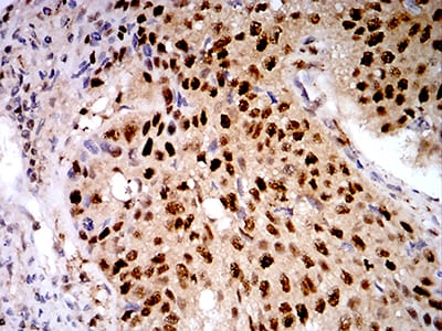 Figure 5:Immunohistochemical analysis of paraffin-embedded lung cancer tissues using LGALS1 mouse mAb with DAB staining.