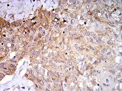 Figure 8:Immunohistochemical analysis of paraffin-embedded esophageal cancer tissues using PLD2 mouse mAb with DAB staining.