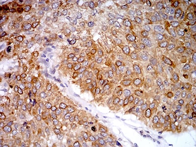 Figure 7:Immunohistochemical analysis of paraffin-embedded lung cancer tissues using PGRMC1 mouse mAb with DAB staining.