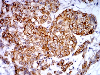 Figure 8:Immunohistochemical analysis of paraffin-embedded breast cancer tissues using PGRMC1 mouse mAb with DAB staining.