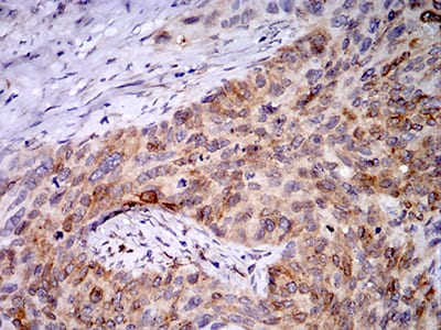 Figure 6:Immunohistochemical analysis of paraffin-embedded cervical cancer tissues using PGRMC1 mouse mAb with DAB staining.