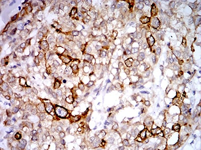 Figure 7:Immunohistochemical analysis of paraffin-embedded breast cancer tissues using PGRMC1 mouse mAb with DAB staining.