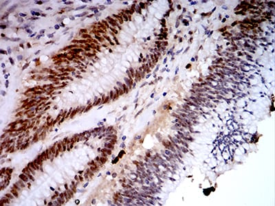 Figure 7:Immunohistochemical analysis of paraffin-embedded colon cancer tissues using KDM1A mouse mAb with DAB staining.