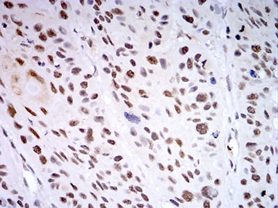 Figure 8:Immunohistochemical analysis of paraffin-embedded esophageal cancer tissues using KDM1A mouse mAb with DAB staining.