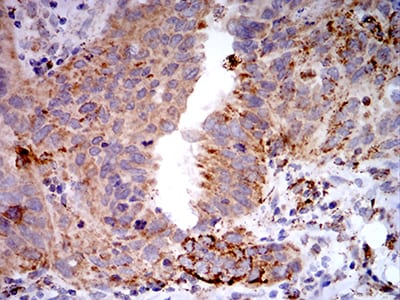 Figure 6:Immunohistochemical analysis of paraffin-embedded ovarian cancer tissues using TLR9 mouse mAb with DAB staining.