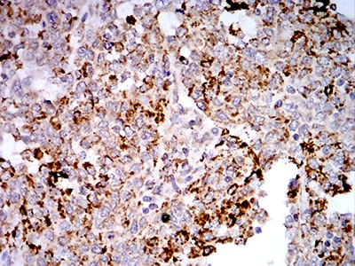 Figure 7:Immunohistochemical analysis of paraffin-embedded endometrial cancer tissues using TLR9 mouse mAb with DAB staining.