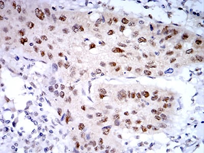 Figure 7:Immunohistochemical analysis of paraffin-embedded lung cancer tissues using PSMC3 mouse mAb with DAB staining.