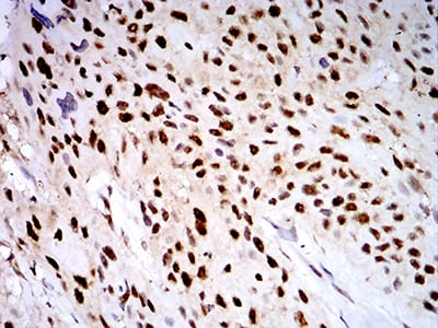 Figure 8:Immunohistochemical analysis of paraffin-embedded breast cancer tissues using PSMC3 mouse mAb with DAB staining.