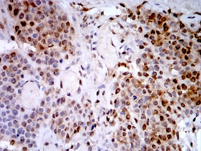 Figure 8:Immunohistochemical analysis of paraffin-embedded bladder cancer tissues using PSMC3 mouse mAb with DAB staining.