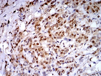 Figure 9:Immunohistochemical analysis of paraffin-embedded breast cancer tissues using PSMC3 mouse mAb with DAB staining.