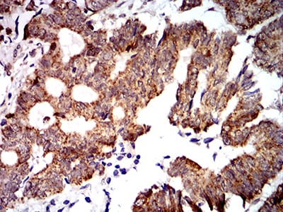 Figure 7:Immunohistochemical analysis of paraffin-embedded rectum cancer tissues using PTPN14 mouse mAb with DAB staining.