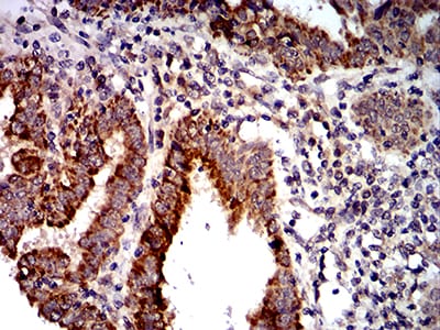 Figure 8:Immunohistochemical analysis of paraffin-embedded endometrial cancer tissues using PTPN14 mouse mAb with DAB staining.