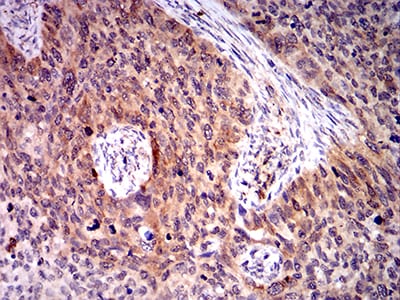 Figure 6:Immunohistochemical analysis of paraffin-embedded cervical cancer tissues using BIN1 mouse mAb with DAB staining.