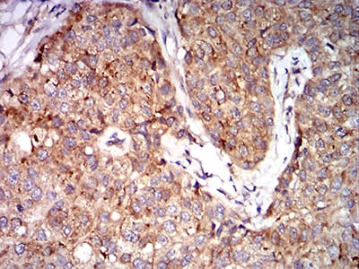 Figure 6:Immunohistochemical analysis of paraffin-embedded bladder cancer tissues using EIF5 mouse mAb with DAB staining.