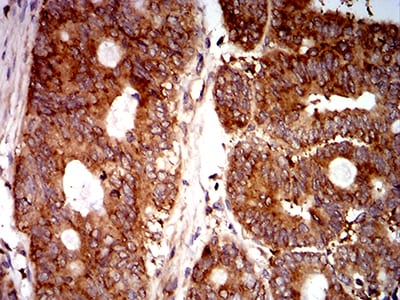 Figure 7:Immunohistochemical analysis of paraffin-embedded rectum cancer tissues using EIF5 mouse mAb with DAB staining.