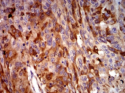 Figure 4:Immunohistochemical analysis of paraffin-embedded ovarian cancer tissues using C3C mouse mAb with DAB staining.