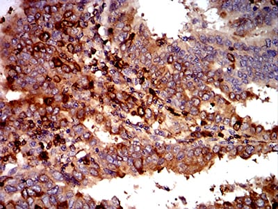 Figure 5:Immunohistochemical analysis of paraffin-embedded endometrial cancer tissues using C3C mouse mAb with DAB staining.