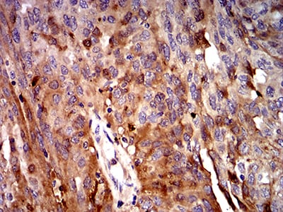 Figure 6:Immunohistochemical analysis of paraffin-embedded ovarian cancer tissues using C3C mouse mAb with DAB staining.