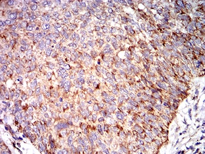 Figure 7:Immunohistochemical analysis of paraffin-embedded bladder cancer tissues using C3C mouse mAb with DAB staining.