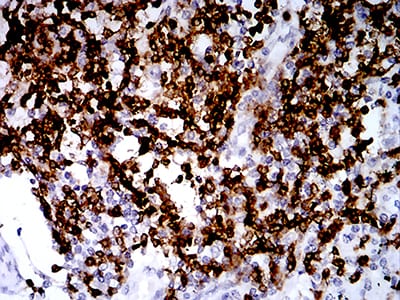 Figure 6:Immunohistochemical analysis of paraffin-embedded lung cancer tissues using CD2 mouse mAb with DAB staining.