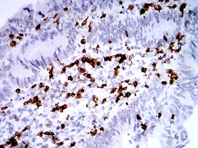 Figure 7:Immunohistochemical analysis of paraffin-embedded rectum cancer tissues using CD2 mouse mAb with DAB staining.