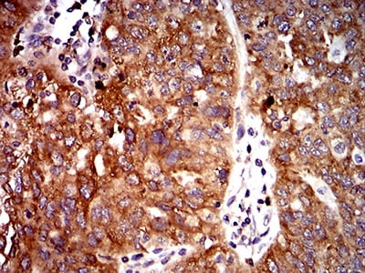 Figure 5:Immunohistochemical analysis of paraffin-embedded ovarian cancer tissues using UFD1L mouse mAb with DAB staining.