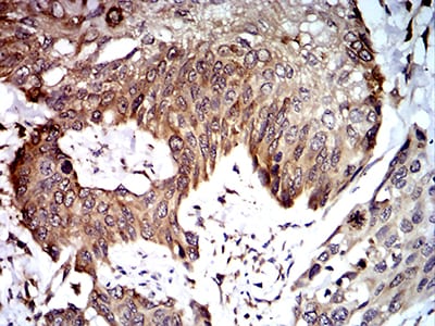 Figure 6:Immunohistochemical analysis of paraffin-embedded esophageal cancer tissues using UFD1L mouse mAb with DAB staining.