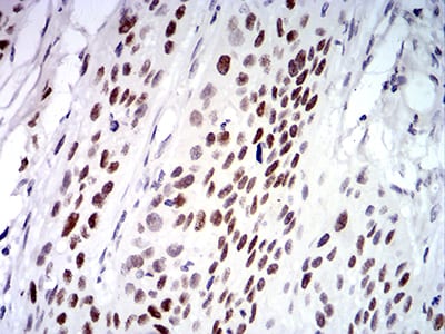 Figure 8:Immunohistochemical analysis of paraffin-embedded esophageal cancer tissues using UFD1L mouse mAb with DAB staining.