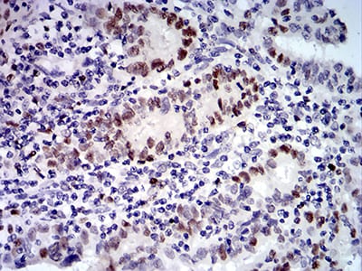 Figure 9:Immunohistochemical analysis of paraffin-embedded endometrial cancer tissues using UFD1L mouse mAb with DAB staining.
