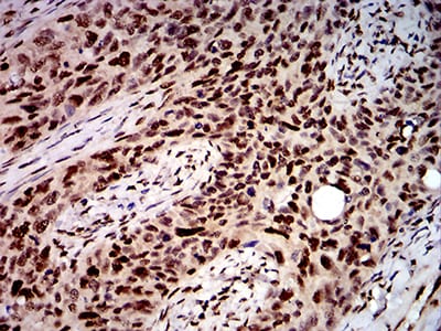 Figure 8:Immunohistochemical analysis of paraffin-embedded cervical cancer tissues using DDX1 mouse mAb with DAB staining.